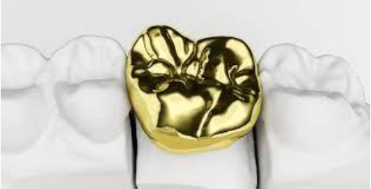 Gouden tanden voor donatie